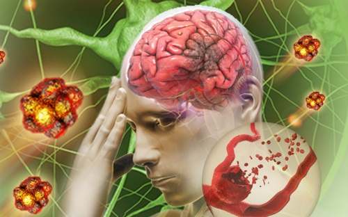Kiểm soát đau đầu giúp dự phòng nguy cơ đột quỵ